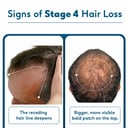 5 - HK Vitals Hair Fall Solution,  STAGE 4
