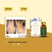 3 - Roopayur Bacne Combo, 2 Piece(s)/Pack Body Acne Cleaning Soap + Bacne Oil